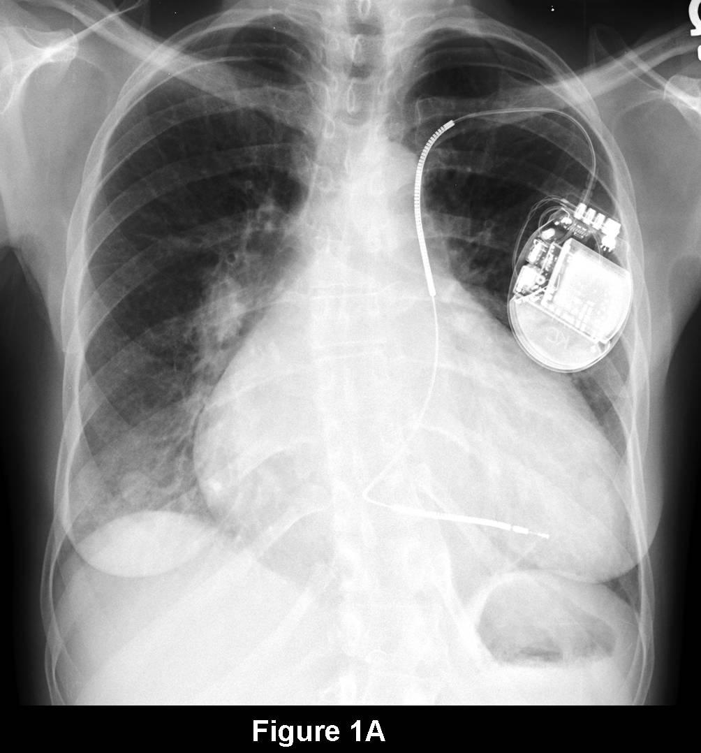 Radiograph 1 from archived case 75