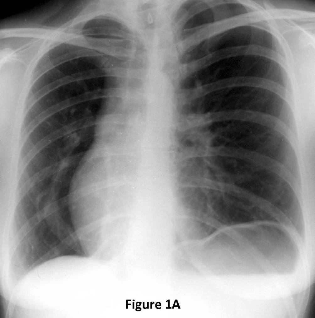 Radiograph 1 from archived case 74