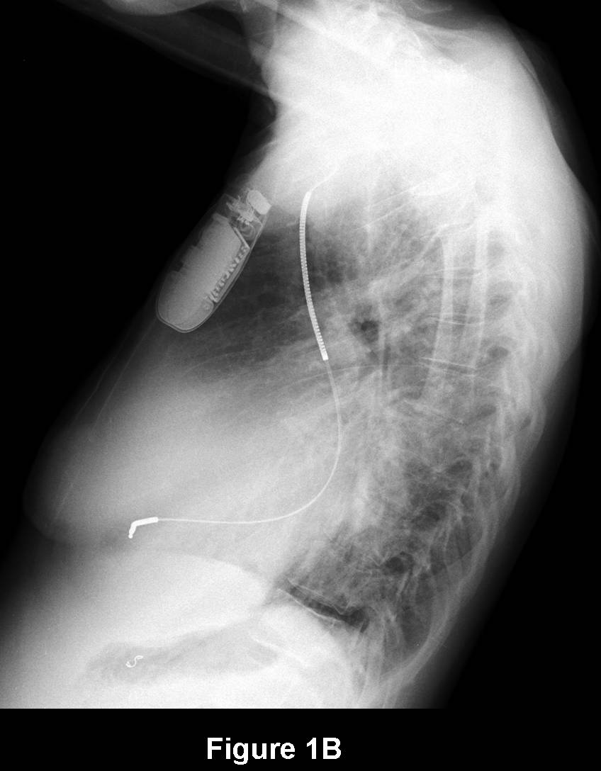 Radiograph 2 from archived case 75